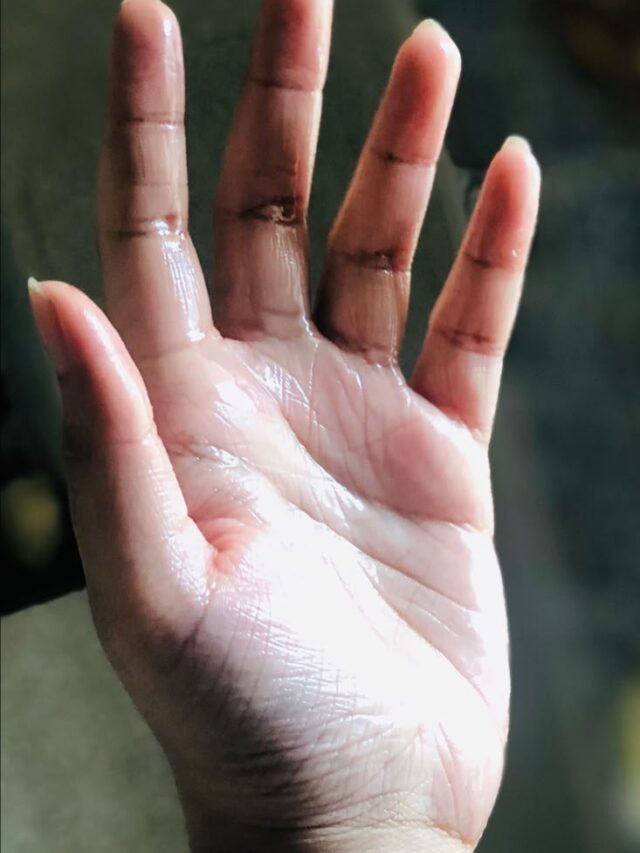 Cure Sweaty Hands Forever