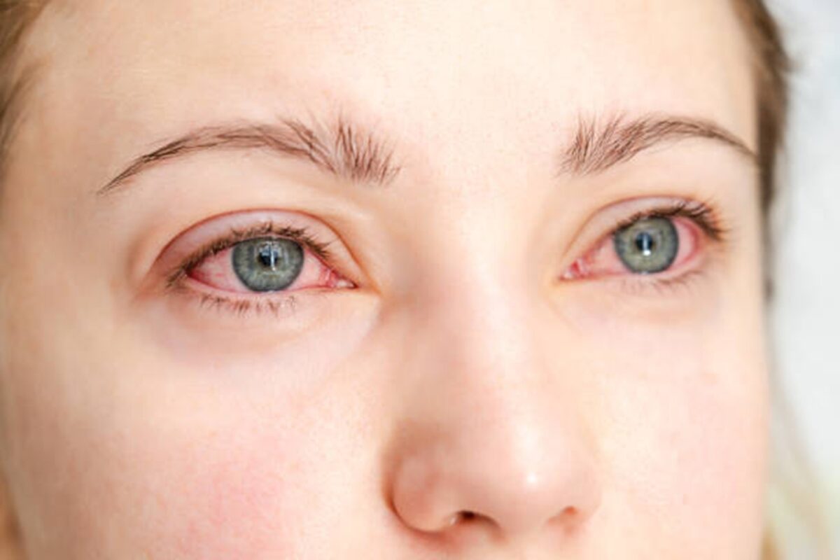 Close-up of red, irritated human eyes showing allergy symptoms and conjunctivitis.